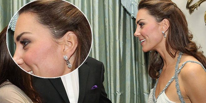 The Real Story Behind Kate's Scar On Her Left Temple